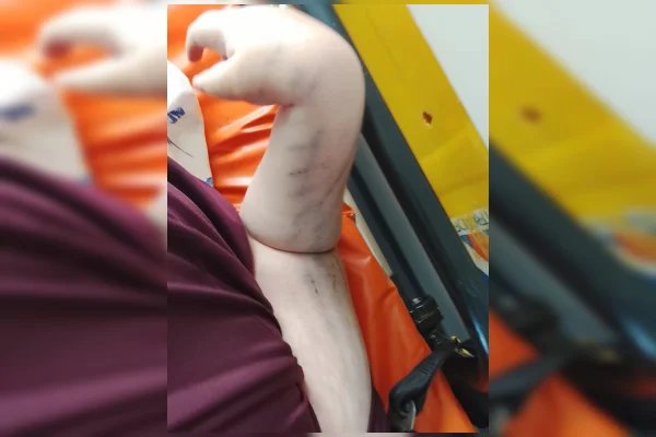 Menino com paralisia que caiu na escada do Metrô passará por cirurgia - destaque galeria